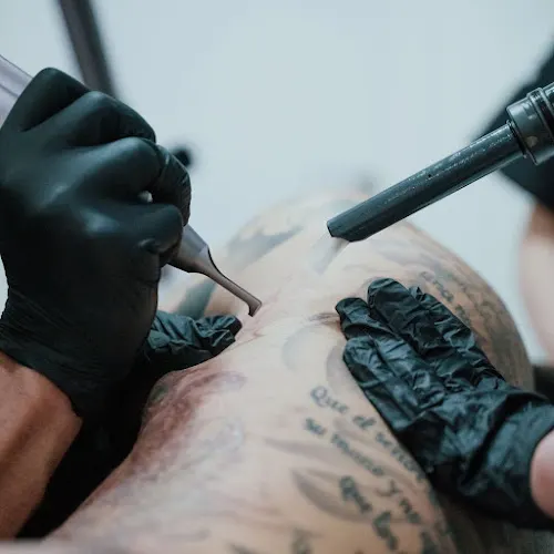 Laser Tattoo Barcelona- Eliminación de tatuajes - Barcelona