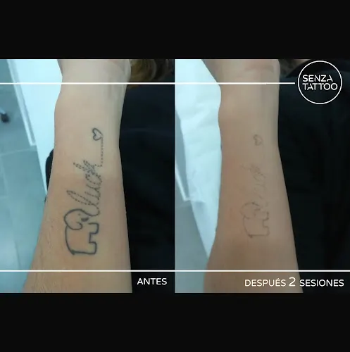 Senza Tattoo L' Hospitalet - Especialistas en eliminación láser de tatuajes - L'Hospitalet de Llobregat