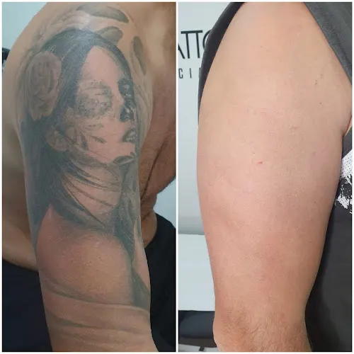 Laser Tattoo Castellón - Servicio de eliminación de tatuajes en Castellón de la Plana