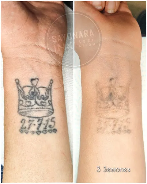 Sayonaraink eliminacion de tatuajes Málaga - Motril