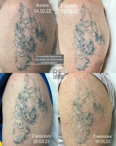 RE.ESTETIC - Servicio de eliminación de tatuajes en Reus