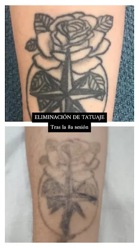 EVERGLOW SKIN - Láser de eliminación de tatuajes y micropigmentaciones - Quart de Poblet