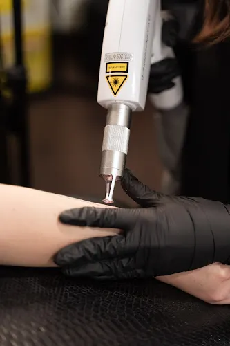 ARC Tattoo Removal - Córdoba