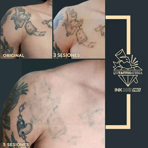 Eliminación de Tatuajes Alcorcón - QUITATTOOAVERIA - Servicio de eliminación de tatuajes en Madrid